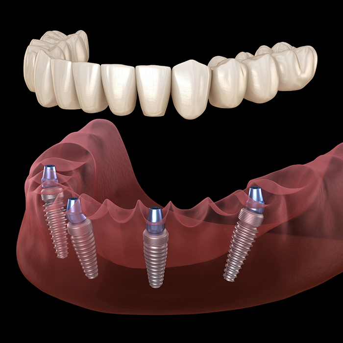 Illustration of a full denture being secured onto four dental implants throughout the arch