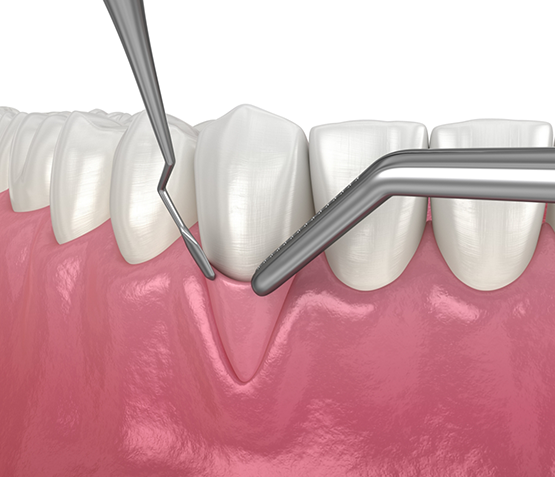 Illustration of a piece of soft tissue being grafted to the receded gums in front of a tooth