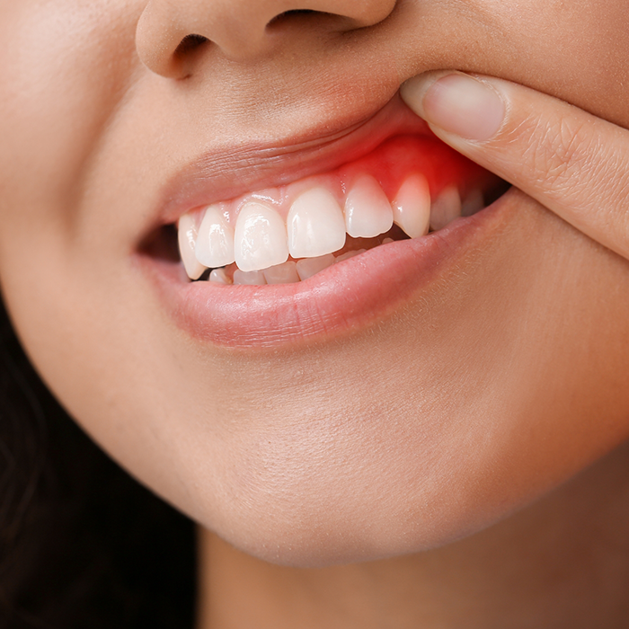 Close up of a person pointing to their red gums