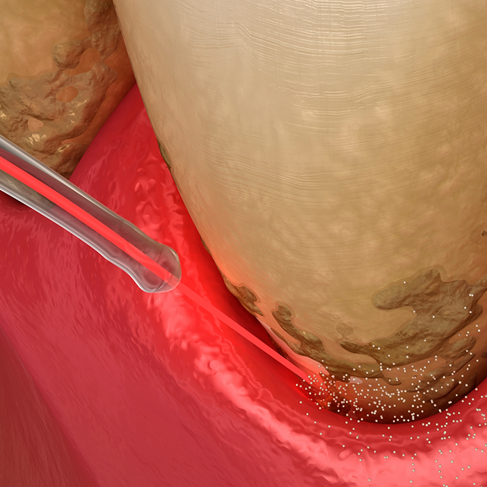 Illustration of a dental laser clearing tartar buildup from the gumline