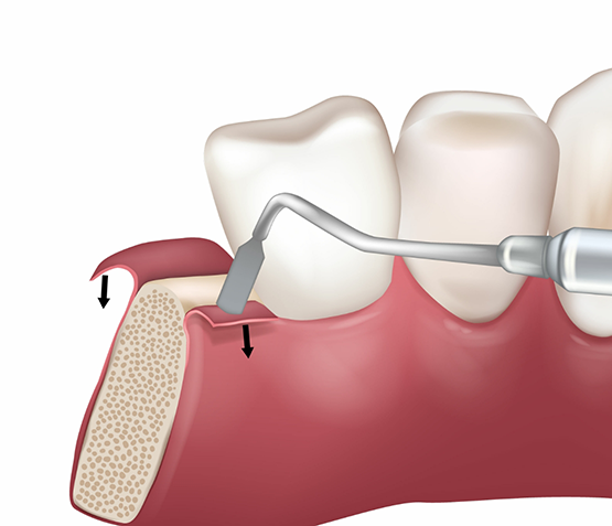Illustration of the gums in front of and behind a lower tooth being peeled down