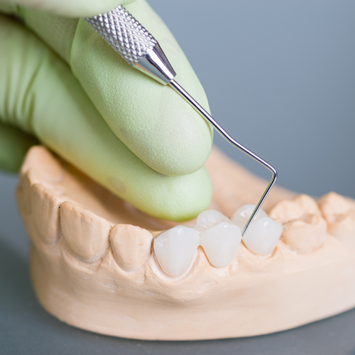 Dentist placing a dental bridge in a model of the mouth to replace three missing teeth