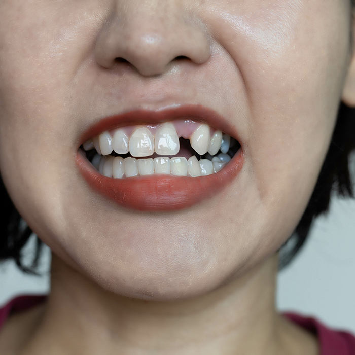 Close up of a person with one missing upper tooth