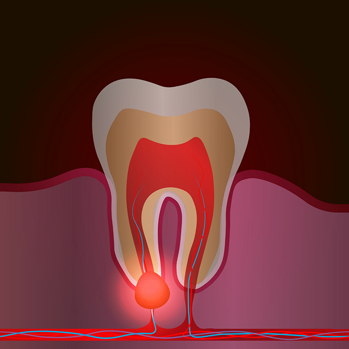 Illustration of a tooth with an infection in the root requiring root canal treatment