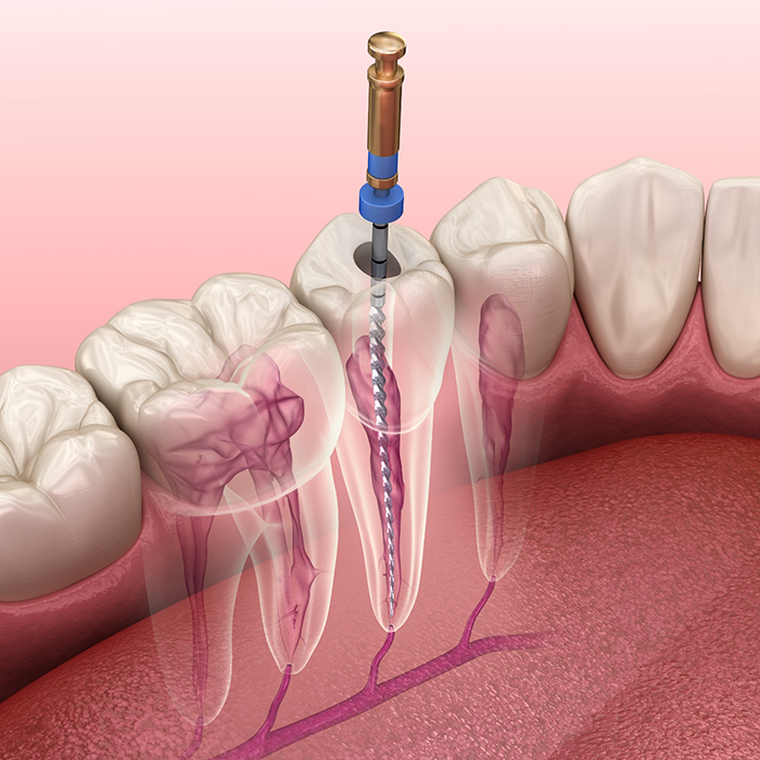 Illustration of a thin dental instrument treating the innermost layer of a tooth