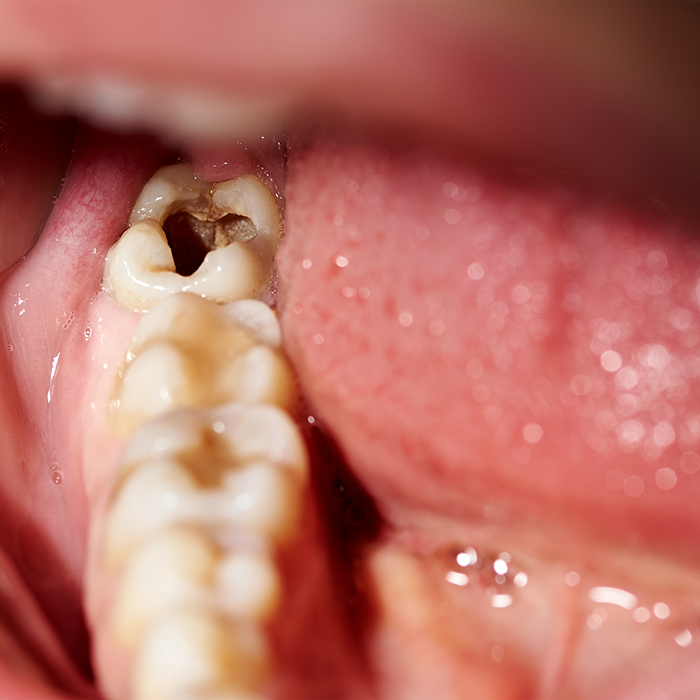 Close up of a mouth with a severely decayed tooth