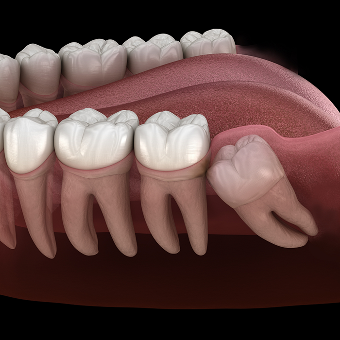 Illustration of an impacted wisdom tooth pressing against the adjacent tooth