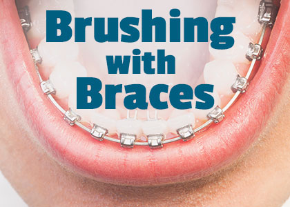 Goose Creek dentists, Dr. Barganier, Dr. Zuffi, Dr. Williams, and Dr. McAdams of [OFFICE] inform patients about the best tools and tricks to use when performing oral hygiene routines with braces.
