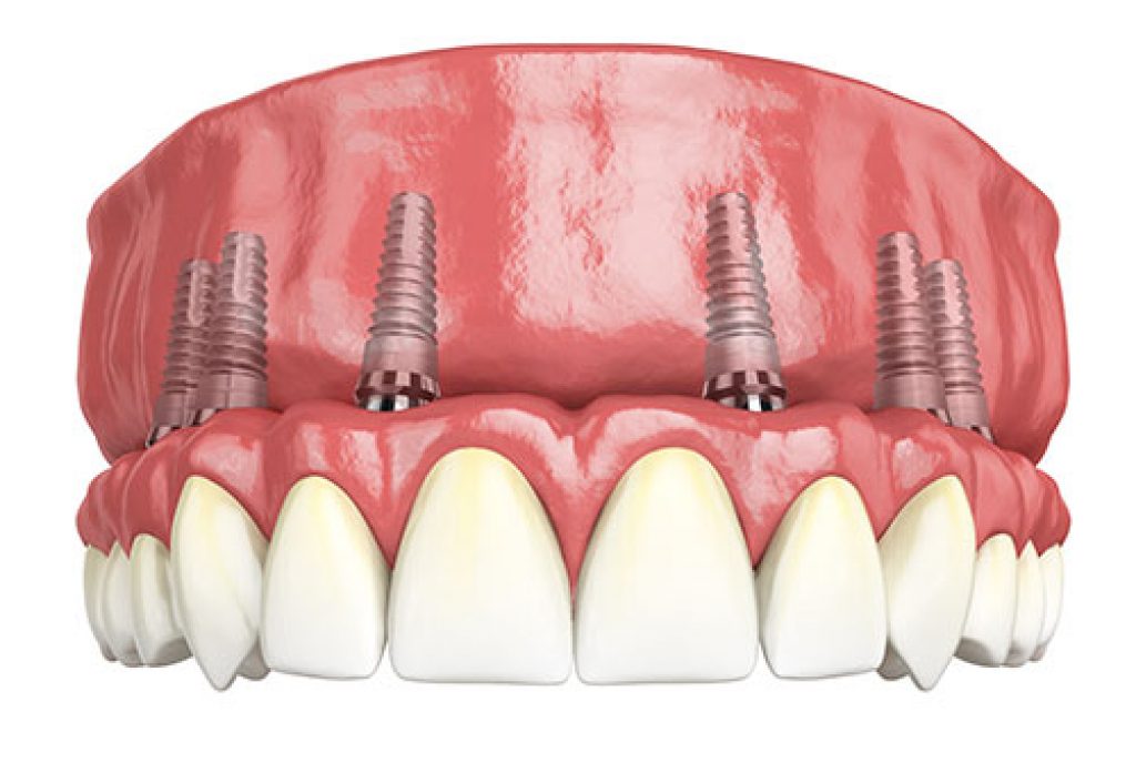 Hybridge® In Goose Creek Sc Carolina Complete Dental