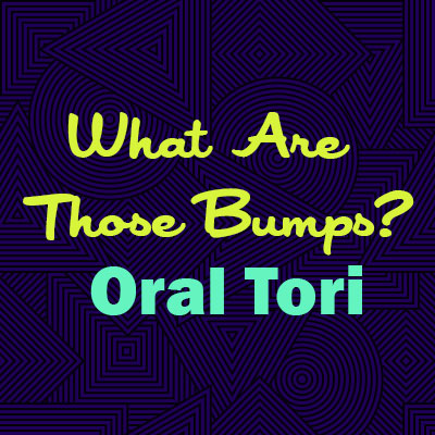 Goose Creek dentist, Drs. Bargainier, and Zuffi at Carolina Complete Dental explains oral tori—what they are, why they happen, and whether they are a cause for concern.